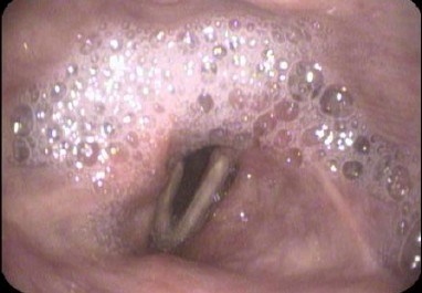 swallowing disorder clinic Bengaluru