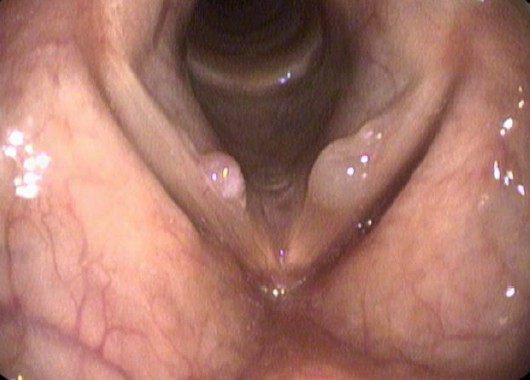 voice disorder treatment in Bengaluru