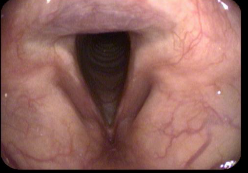 Why Bengaluru’s Air is Making Your Voice Feel 'Heavy': The Truth About Environmental Laryngitis Laryngitis- Kushaan ENT and Voice clinic